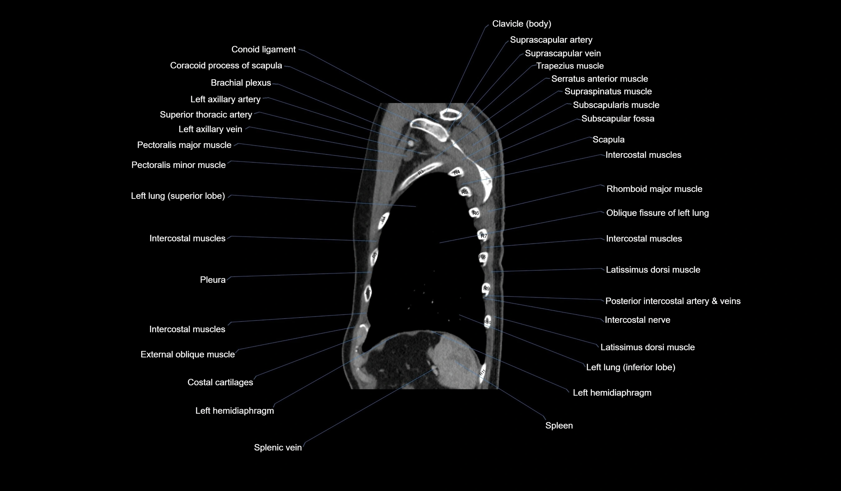 CT chest (thorax) labelled sagittal cross sectional anatomy radiology image-00119.webp